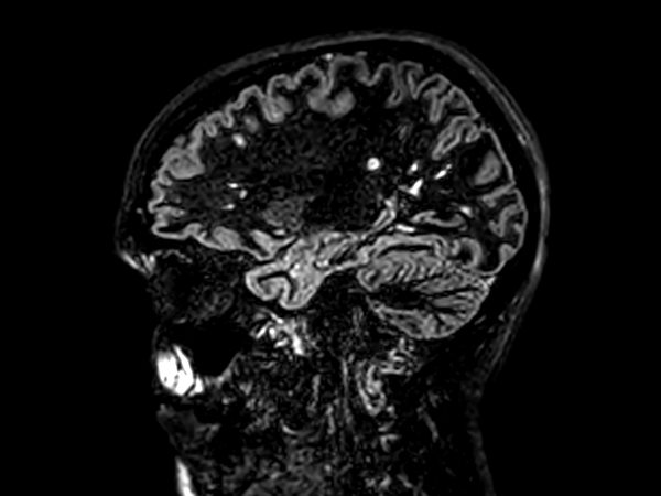 Полностью загерметизированный магнит Ingenia Ambition X с системой микроциркулярного охлаждения BlueSeal содержит всего 7 литров гелия, не требует монтажа труб и сложного обслуживания